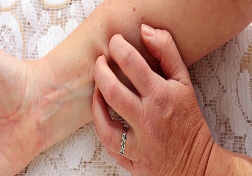 رفع خارش پوست به روش های گیاهی و خانگی