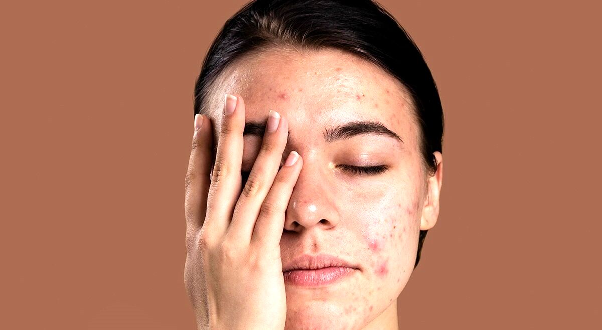 تاثیر مزاج در جوش زدن
