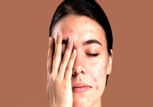 مزاج چه تاثیری روی جوش های پوستی و بدن داره؟ 