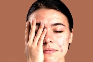 مزاج چه تاثیری روی جوش های پوستی و بدن داره؟ 
