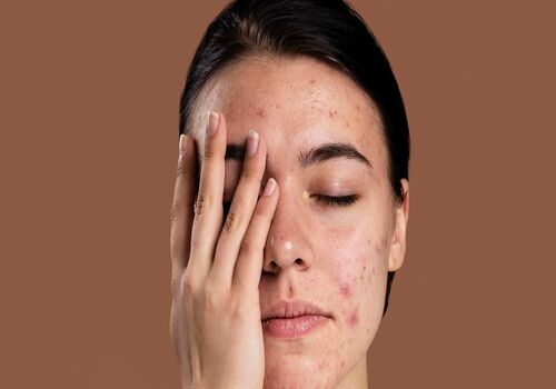 مزاج چه تاثیری روی جوش های پوستی و بدن داره؟ 