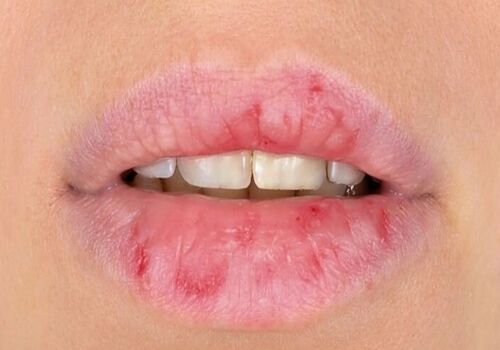 ویتامین ها چه ارتباطی با خشکی و پوسته شدن لب ها دارن؟ 